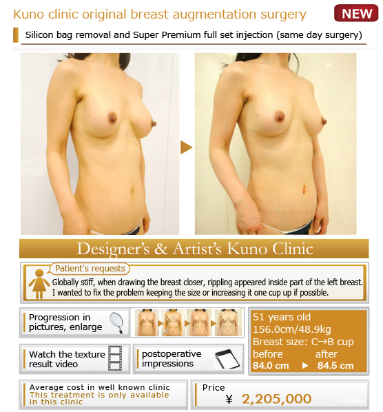 Kuno clinic original breast augmentation surgery